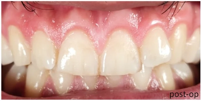 Sonra: Periodontal tedavi ile diş eti sağlığının ve görünümünün iyileştirilmesi.