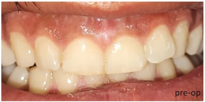 Önce: Periodontal tedavi ile diş eti sağlığının ve görünümünün iyileştirilmesi.